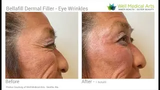 Bellafill Filler for Eye Wrinkles when Botox is not enough