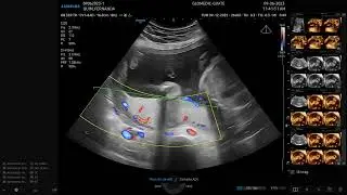 3D PLACENTA con Doppler Color en el v7