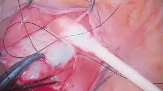 Segmental scleral buckle with drainage