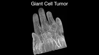 Giant Cell Tumor