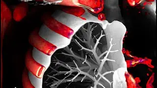 Pulmonary angiography ct reconstruction