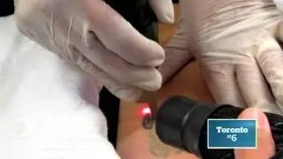 Dr. Sean Rice - Picosure Tattoo Removal - CBC News