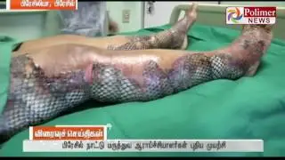 Brazil  uses fish skin to treat skin scars ! | Polimer News | 