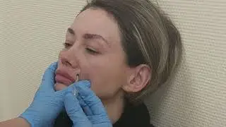 Ботокс при морщинах на лбу.