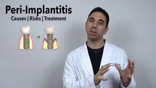 Peri-Implantitis (Infected Dental Implant Treatment Options)