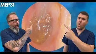 VERY DIFFICULT DEEP EAR WAX REMOVAL - MEP31