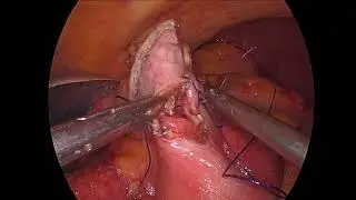 Anastomosi Gastro-digiunale ad Y sec. Roux Laparoscopica dopo Gastrectomia Subtotale Laparoscopica