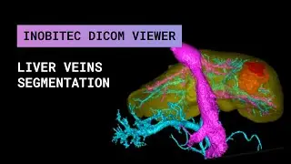 Liver veins segmentation in Inobitec DICOM Viewer Pro 2.3