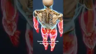 Cervical Spinal Stenosis with Myelopathy Symptoms