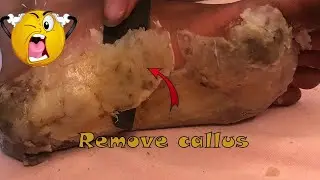 How to removal skin | callus removal skin flakes #32