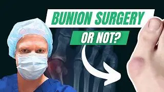 Bunions - Do I need SURGERY or NOT?