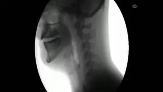 X ray  A person swallowing water