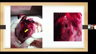 FORENSIC PATHOLOGY: IATROGENIC INJURY