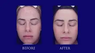 IPL Photorejuvenation 101 |Weiler Plastic Surgery Group