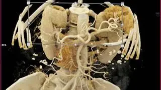 Pancreas Cancer Preop Planning with Cinematic Rendering
