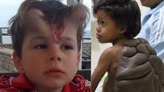 Top 5 Strangest Birthmarks