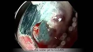 ESD resection of a gastric submucosal tumor (fibroid inflammatory polyp)