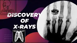 Discovery of X-rays | Radiotherapy Edutech #discovery #xrays #radiology #radiotherapy #radiation