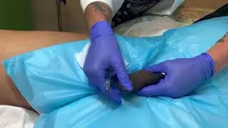 Penis Enlargement Procedure using dermal fillers in Seattle at Well Medical Arts.