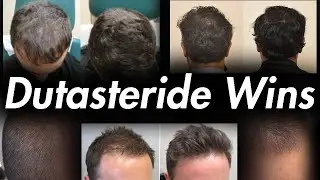 Dutasteride is for Young Hair Loss Suffers