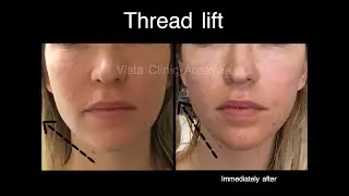 Training: threadlift types: mono, meso, barbs, cogs, absorbable, permanent. Pros and cons