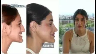 Cirugía bimaxilar Caso #149: Isela- Clase III, hipoplasia maxilar, hiperplasia mandibular