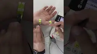 #ЭМГ Рассказываем о методиках диагностики синдрома карпального канала