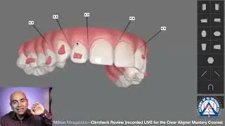 Clear Aligner Tip: Change the Size and Location of Optimized Attachments!
