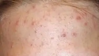ПРЫЩИ.Как избавиться.Мой опыт.