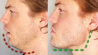Why Mouth Breathing Is Destroying Your Face