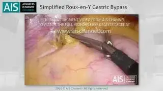 Simplified Roux-en-Y Gastric Bypass