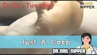 Just a Corn #14 - Callus Tuesday