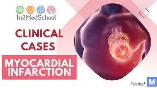 Myocardial infarction  Clinical Case
