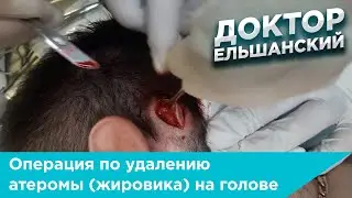 Операция по удалению атеромы (жировика) на голове