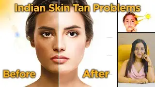 Say No To Getting Tanned, Precautions & Remedies for Tanning | Dr. Priyanka Ghatge