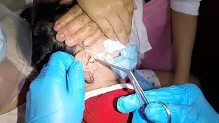 Removing Cotton with Earwax Stuck in Boy's Ear
