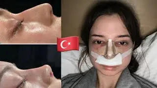 I GOT A NOSE JOB IN TURKEY | Rhinoplasty Vlog with Dr. Yusuf Orhan Ucal at Clinic Hub Istanbul