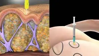 Qwo® Injection Technique Instructional Video - Florida Plastic Surgery Group - Jacksonville, FL