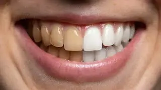 Teeth Whitening Easily Explained - All You Need To Know About Teeth Whitening