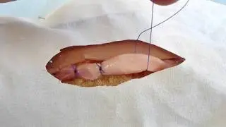 Ligation of vessels at distance