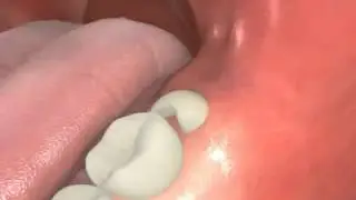 Extraction de dent de sagesse