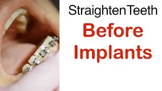 Straighten Teeth Before Implants