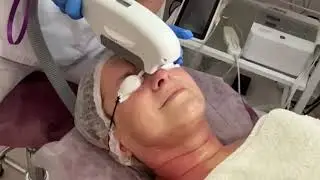 Elos омоложение
