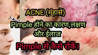 ACNE (मुंहासे)||Pimple होने का कारण,लक्षण और ईलाज||Pimple को कैसे रोकें ||