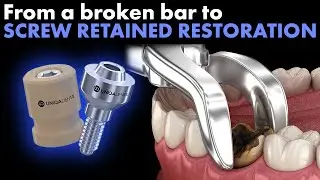 From a broken bar to screw retained restoration. Digital impression by Uniqa Dental