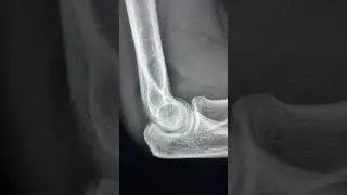 Positive posterior fat pad sign and bulging anterior fat pad sign - Classic case