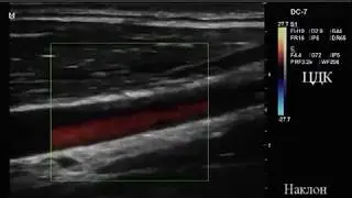 Анонс - физика и настройки допплерографии, общие принципы оценки сосудов