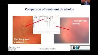 AI for Retinopathy of Prematurity - Dr. J. Peter Campbell
