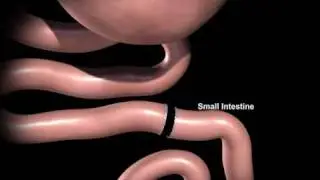 Laparoscopic Gastric Bypass Surgery - Texas Laparoscopic Consultants
