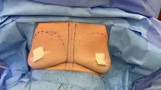 Treating Capsular Contractures and Waterfall Deformities with Capsulectomy and Explant! 